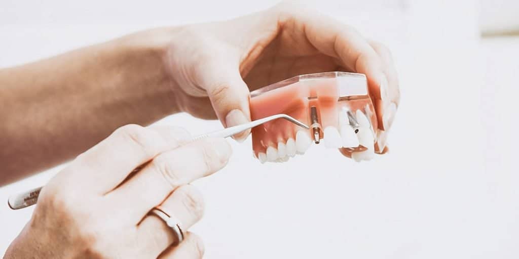 Dental implant cost in Armenia